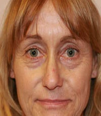 blepharoplasty (eyelids) before 219335