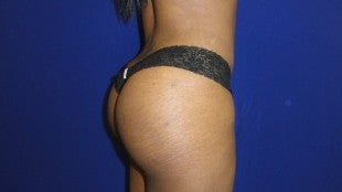Brazilian Butt Lift after 476148