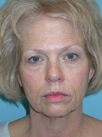 Full Facial Rejuvenation before 148572