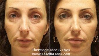 Thermage skin tightening for face and eyes before 71108