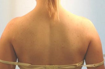 Laser Back Acne Treatment before 82961