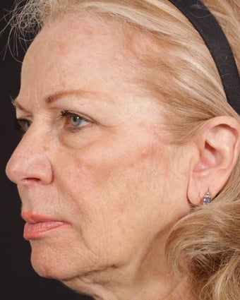 Sculptra before 277735