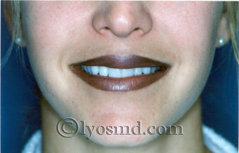 Lip Augmentation after 225580