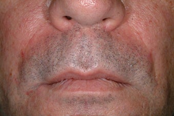 Evolence injections after 86803