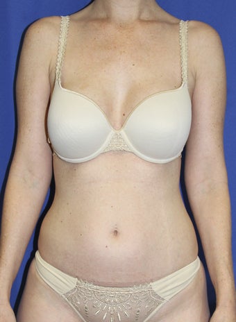 Laser-assisted Liposuction before 364499
