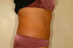 Lipo-abdominoplasty after 87342