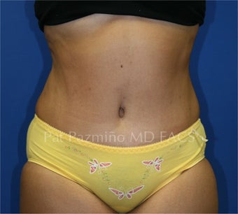 Tummy tuck after 199309