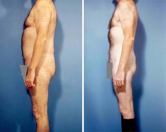 Liposuction before 636113