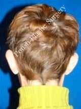 Ear Surgery (Otoplasty) before 584557