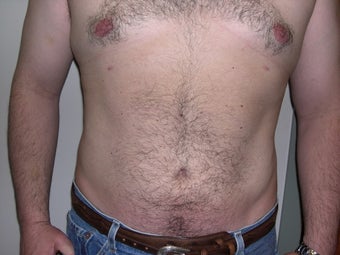 Liposuction after 340028