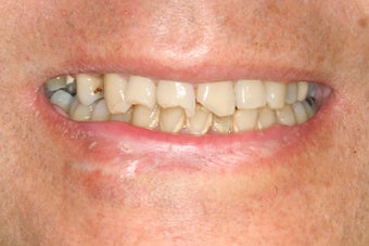 Dental implants, bone graft, all porcelain crowns and veneers before 503162