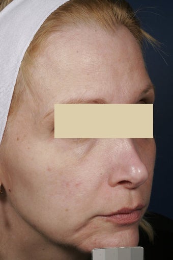 Fraxel repair before 135918