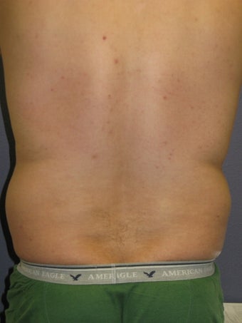Liposuction Male 575522