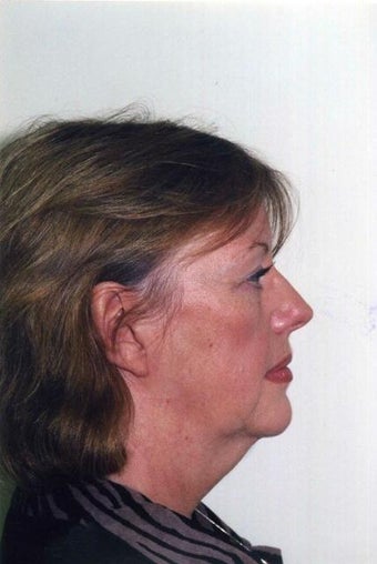 Neck Lift before 215151