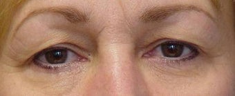Upper Blepharoplasty before 251707