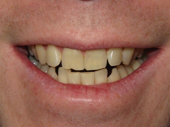 KOR Deep Bleaching System before 398116