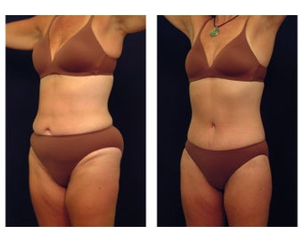 Tummy Tuck or Abdominoplasty before 283087