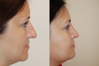 Rhinoplasty before 129185