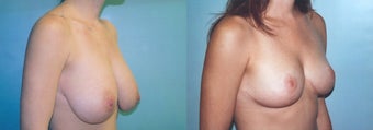 Breast Reduction using Inverted T incision before 352711