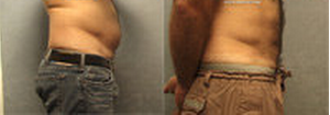 Vaser Liposelection after 99281