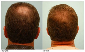 Crown (Vertex) Hair Transplant before 134768