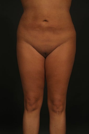 Liposuction after 315578