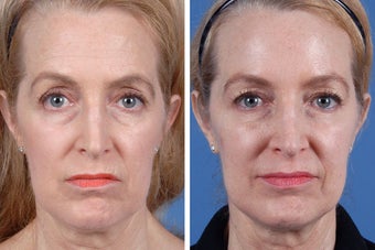 Restylane and Botox Cosmetic before 356495