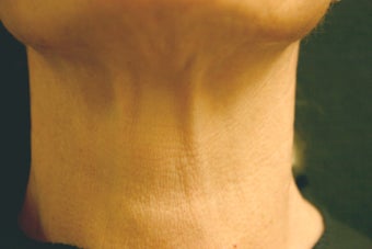 Botox after 410999