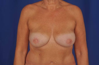 56 Year-Old Woman with Bilateral Breast Reconstruction after 647197