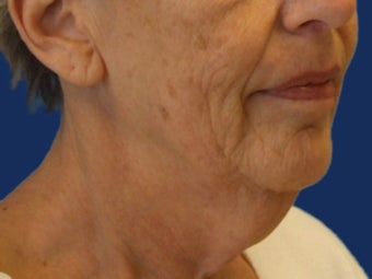 Lower Facelift and Necklift with Platysmaplasty before 243449