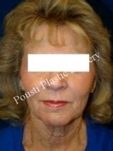 Face Lift, Neck Lift before 632177