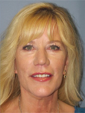 Neck Lift, Platysmaplasty after 634737