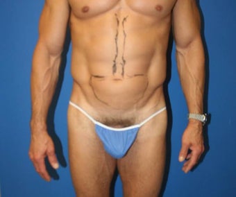 High-Definition Liposuction before 402412