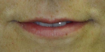 Lip Augmentation before 223122