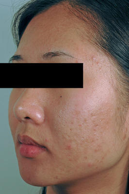 Laser Acne Scar Removal before 82972