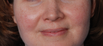 IPL Treatments after 354044