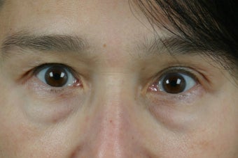 Restylane to Tear Trough before 308294