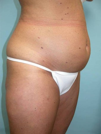 Abdominoplasty and Liposuction before 148592