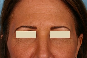 Frown lines treatment after 88694