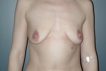 Breast lift with augmentation before 165876