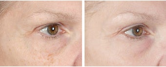 Active FX Fractional Laser Resurfacing before 253995