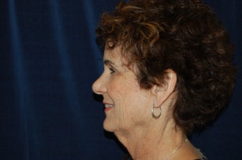 Facelift 336453