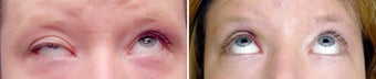 Revisional ptosis repair of left upper eyelid before 155084