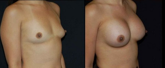 Breast Implants after 150821