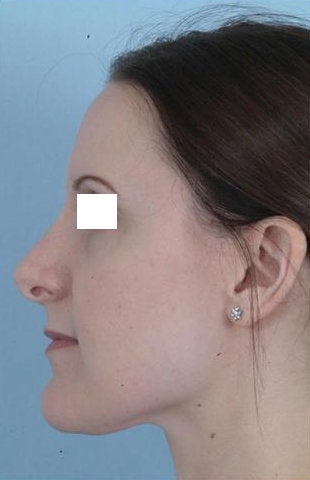 Revision Rhinoplasty before 100950