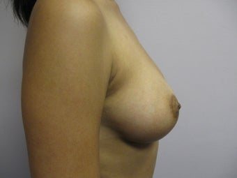 Breast Augmentation 382786