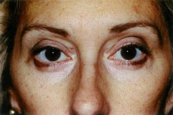 Blepharoplasty (lower eyelid surgery) after 278476