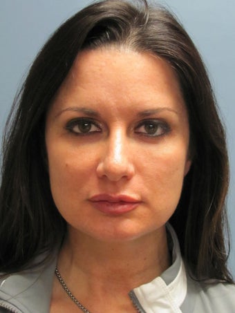 Neck Lift, Platysmaplasty before 634730