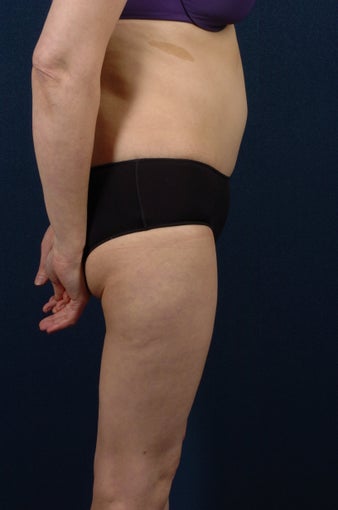 Abdominoplasty (tummy tuck) after 267668