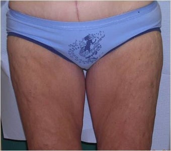 Thigh lift after 589904